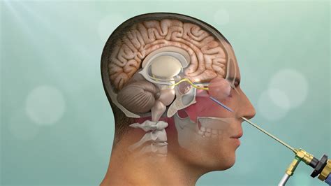 Endoscopic Pituitary Adenoma Surgery: Safety First | Pacific ...