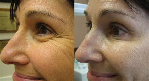 Wrinkle Treatment Before and After: Botox, Dermal Fillers