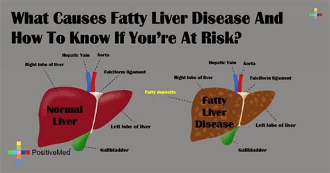 Fatty Liver Disease