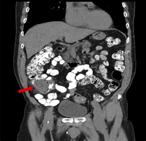 Colonic Mass After NSAID Use and Concerns for Malignancy : ACG Case ...