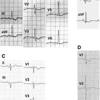 Repolarization abnormalities. Examples of ECG recordings showing ...