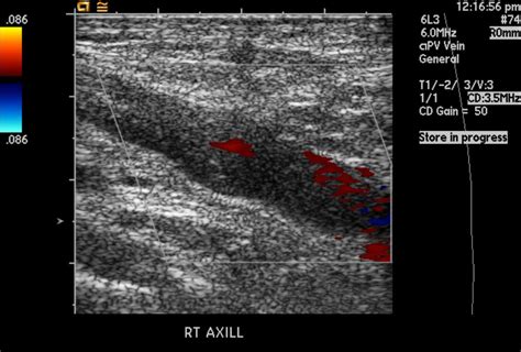 Thromboembolism ultrasound - wikidoc