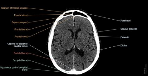 Normal Brain Ct Anatomy