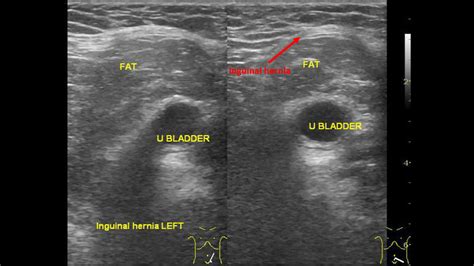 Inguinal hernia ultrasound - wikidoc