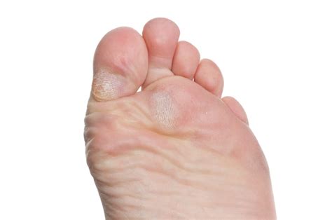 Corns vs. Calluses | Symptoms & Treatments | Arizona Red Mountain Footcare