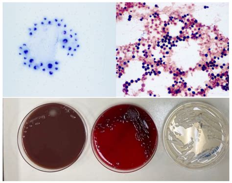 Microbiology Case: Immunocompromised Patient with Altered Mental Status ...