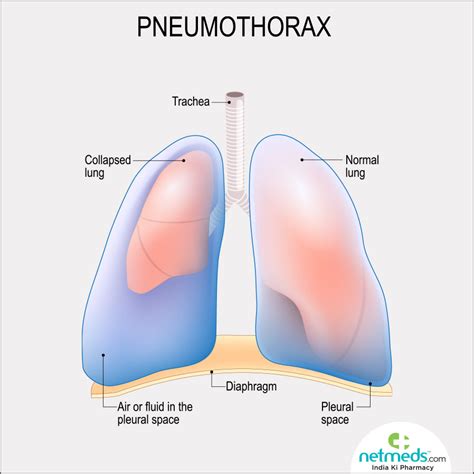 Pneumothorax – Causes, Symptoms And Treatment | Netmeds