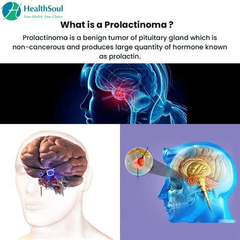 Prolactinoma: Symptoms, Causes and Treatment – Healthsoul