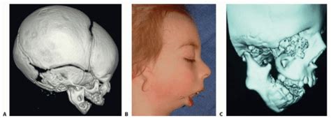 External Mandibular Distraction for Micrognathia | Plastic Surgery Key