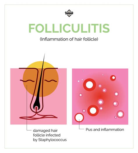 A Spotlight On Folliculitis | Diamond CARE - WhiskersBazaar