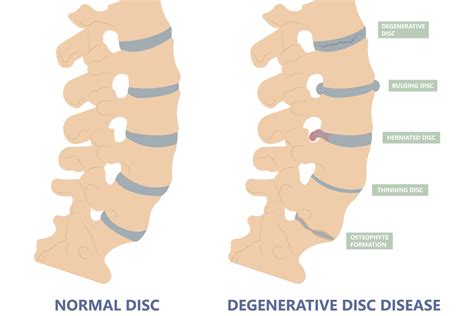 Degenerative Disc Disease Causes, Symptoms & Treatments | Advanced ...