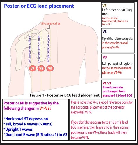 Ekg Lead Placement Diagram