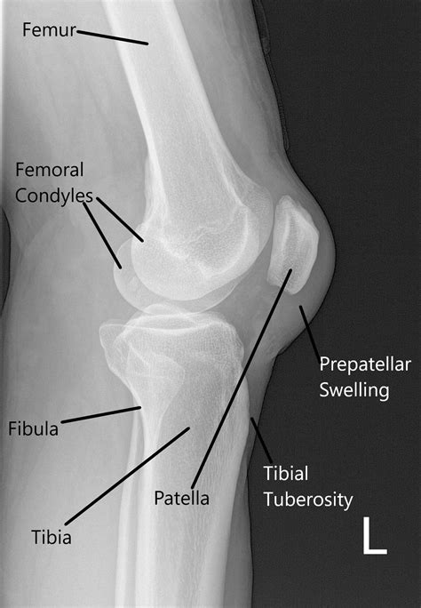 Lateral Knee X Ray Positioning