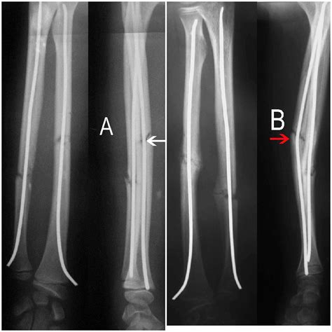 Pdf Retrograde Fixation Of The Ulna In Pediatric Forearm Fractures ...