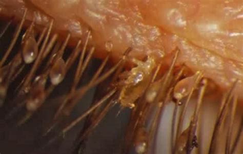 Eyelash Mites, Demodex, Symptoms, Acne, Mascara, Causes, Video ...