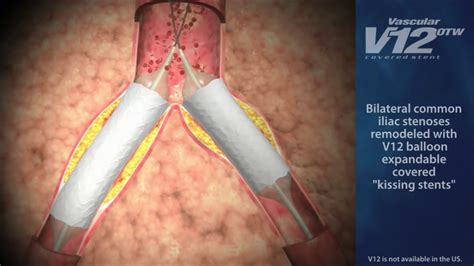 Kissing Iliac Stents