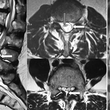 Intraoperative photo shows the thickened ligamentum flavum cyst wall ...