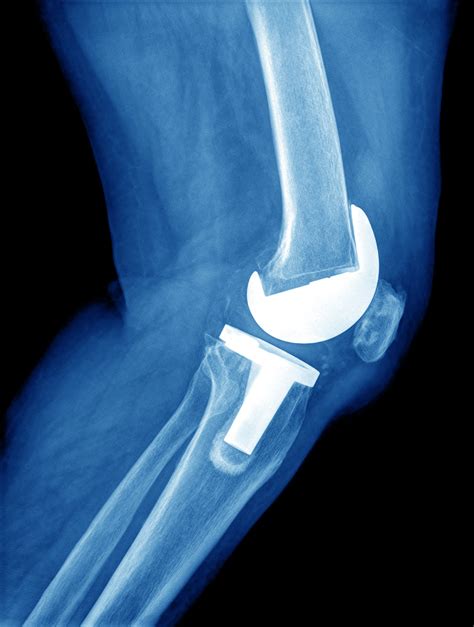 knee-replacement-x-ray - The Orthopedic & Sports Medicine Institute in ...