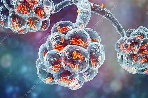 Bacterial pneumonia, illustration - Stock Image - F022/4258 - Science ...