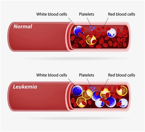 Leukemia Information | Knight Cancer Institute | OHSU