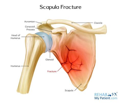 Scapula Fracture | Rehab My Patient