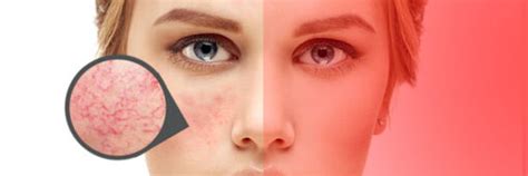 Light therapy for rosacea - Red Light Man