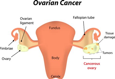 The Ovarian Cancer Symptoms You Should Never Ignore – Health Blog ...