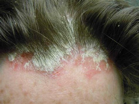 What Does Psoriasis Look Like