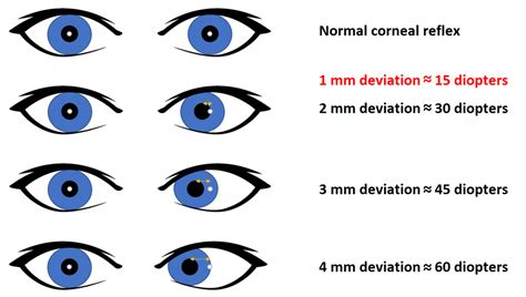 Corneal Reflex