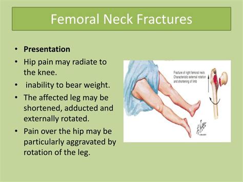 PPT - Common lower limb fracture PowerPoint Presentation - ID:5737068