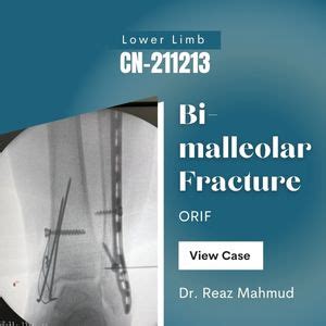 Bimalleolar Ankle Fracture | ORIF [CN-211213] - Dr. Reaz Mahmud