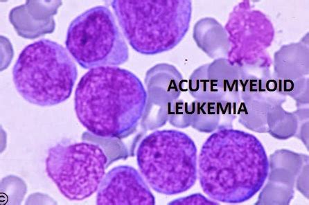 Acute Myeloid Leukemia | CheckRare.com