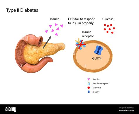 Pancreas Diabetes Diagram