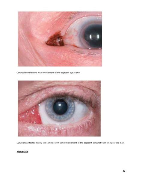 Conjunctival tumors