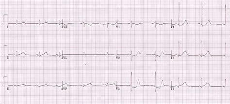 Posterior Myocardial Infarction • LITFL • ECG Library Diagnosis