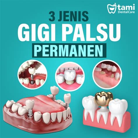 3 JENIS GIGI PALSU PERMANEN – Tami Dental Care – Klinik Dokter Gigi ...