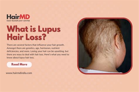 What is Lupus Hair Loss? Symptoms of Lupus: HairMD, Pune