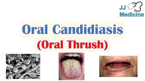 Oral Thrush In Babies Cks