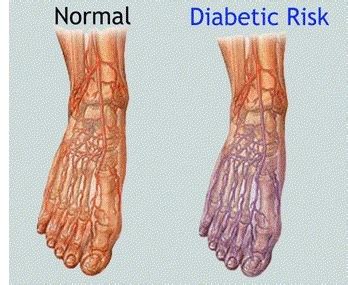 Nerve Pain In Foot: Causes, Symptoms & Diagnosis