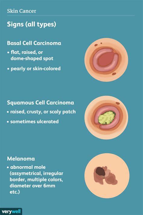 Skin Cancer: Signs, Symptoms, and Complications