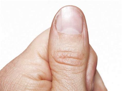 Nail Psoriasis: Pictures, Symptoms, and Treatments