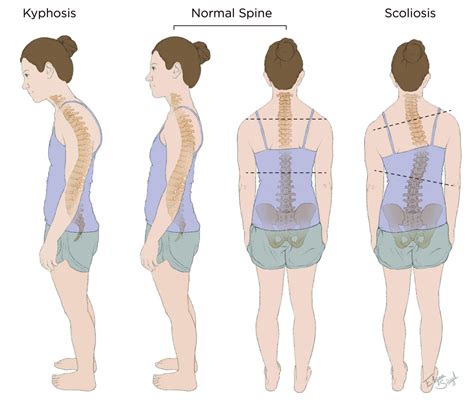 Kyphosis/Scoliosis - Goodman Campbell