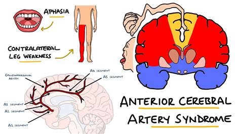 Cerebral Artery Occlusion Pathophysiology - mapasgmaes