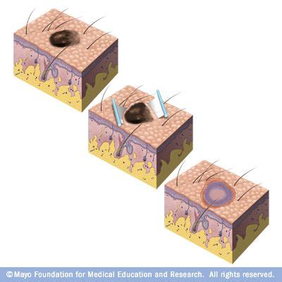 Shave biopsy | Pediatric cancer, Cancer care, Cancer support