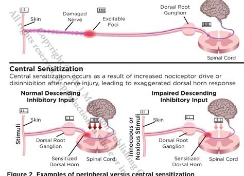 Figure 2 from Postherpetic Neuralgia : An Overview of the ...