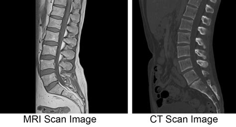 MRI vs. CT Scan; Diagnosing Spine & Neck Injuries & Degenerative Diseases