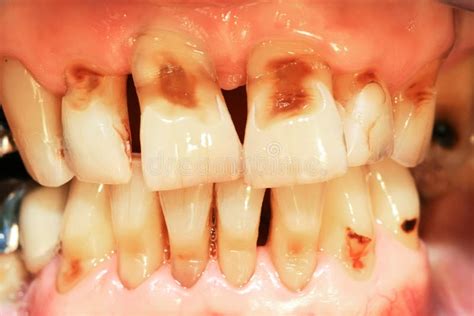 Teeth abrasion stock image. Image of clinic, exam, decay - 28636143