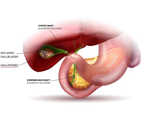 Gallbladder Stone - Nexus Surgical