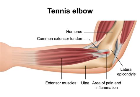 Elbow Injury Torn Tendons Tendonitis Repair | atelier-yuwa.ciao.jp