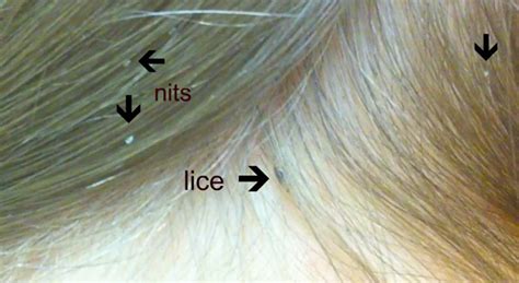 How to Calculate How Long You Have Had Lice | Fresh Heads Lice Removal